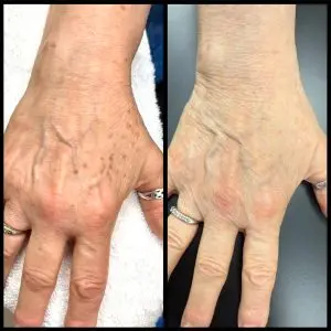 Light and Bright Laser Treatment