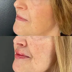 Lip Filler