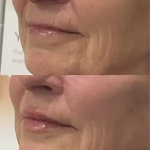 Lip Filler