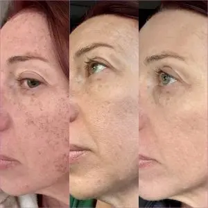 Laser Skin Treatment Progression