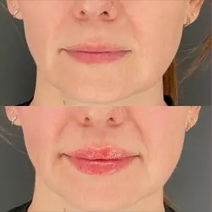 Lip Filler