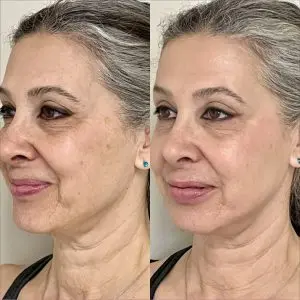 Light and Bright Laser Treatment