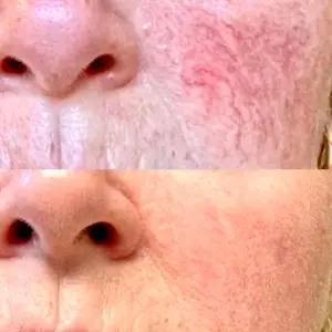 Light and Bright Laser Treatment