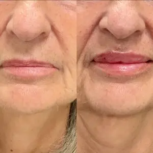 Lip Filler