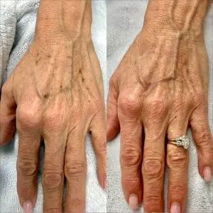 Light and Bright Laser Treatment