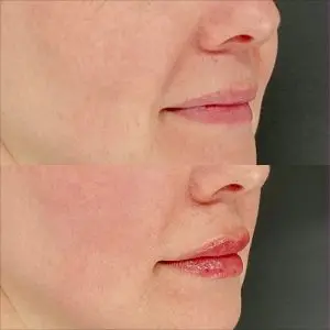 Lip Filler