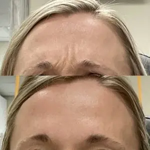 Botox