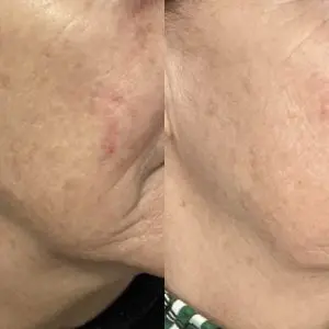 Light and Bright Laser Treatment