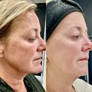 Light and Bright Laser Treatment