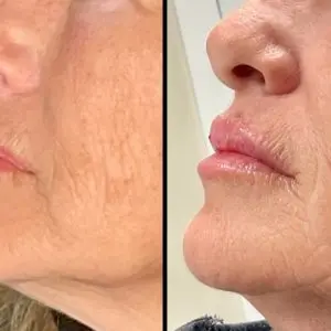 Lip Filler