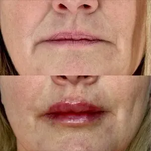 Lip Filler