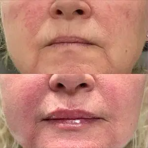 Light and Bright Laser Treatment