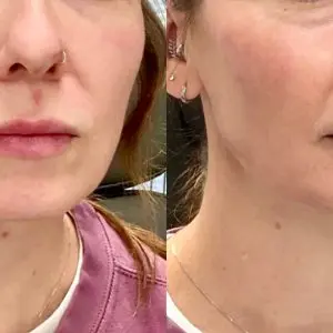 Dermal Filler