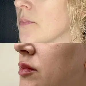 Lip Filler
