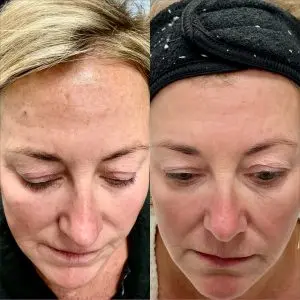 Light and Bright Laser Treatment