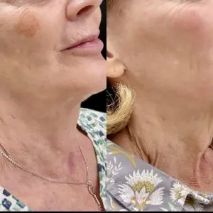 Light and Bright Laser Treatment