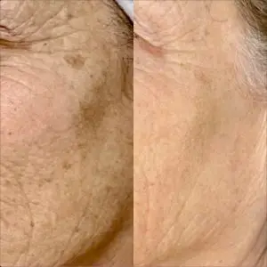 Light and Bright Laser Treatment