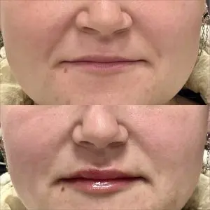 Lip Filler