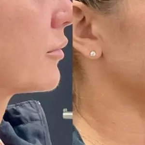 Lip Filler