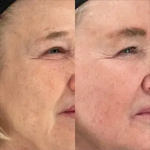 Light and Bright Laser Treatment