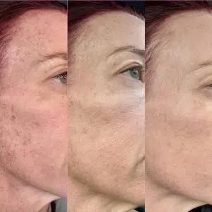 Laser Skin Treatment Progression