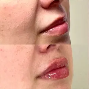 Lip Filler