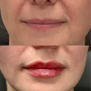 Lip Filler