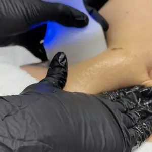 NeveSkin Skin Treatment