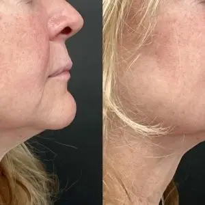Lip Filler