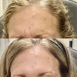 Botox