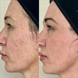 Light and Bright Laser Treatment
