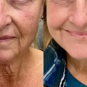 Light and Bright Laser Treatment