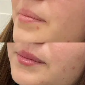 Lip Filler