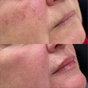 Lip Filler