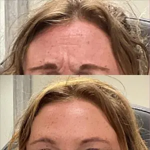 Botox