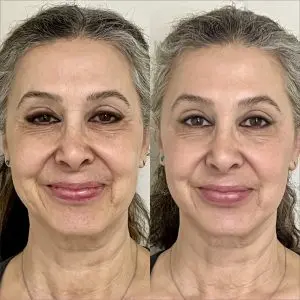 Light and Bright Laser Treatment
