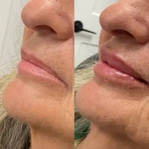 Lip Filler