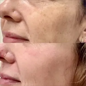 Light and Bright Laser Treatment