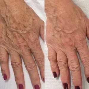 Light and Bright Laser Treatment