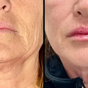 Lip Filler