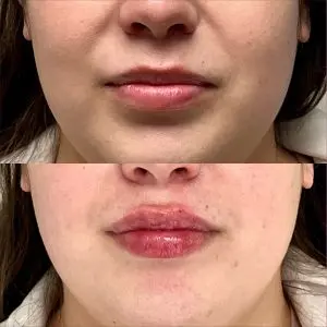 Lip Filler
