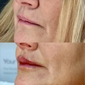 Lip Filler