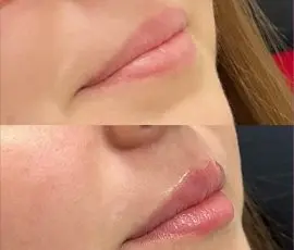 Lip Filler