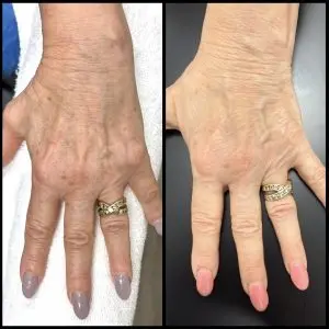 Light and Bright Laser Treatment