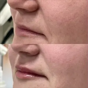 Lip Filler