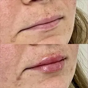 Lip Filler
