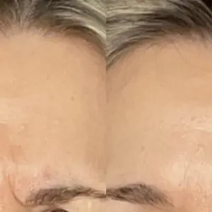 Botox