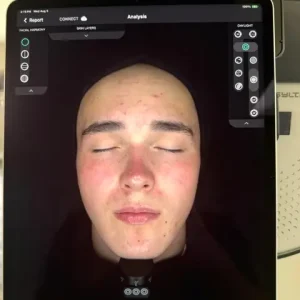 Skin Analysis