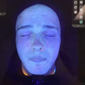 Skin Analysis