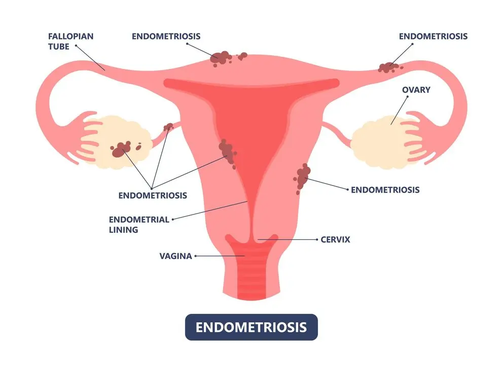Endometriosis 2 Endometriosis